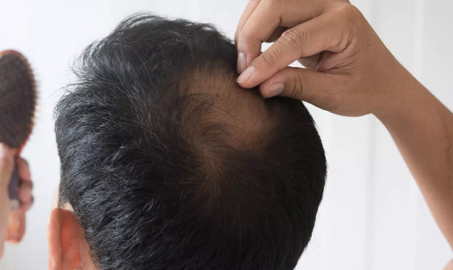 Voici l’âge auquel les hommes commencent souvent à perdre leurs cheveux : « si c’est plus tôt… c’est mauvais signe »